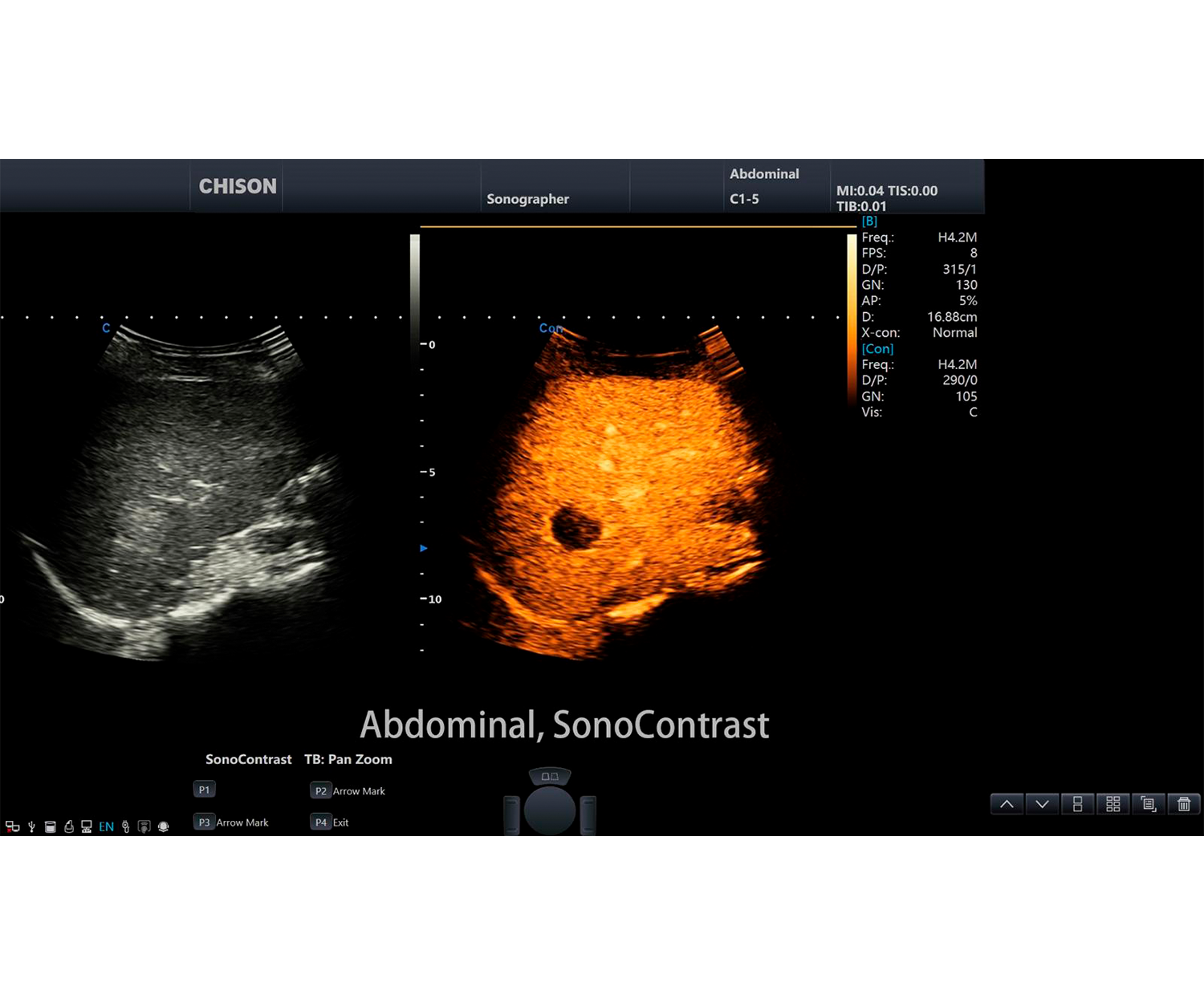 SonoMax abdominal SonoContrast